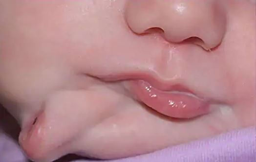 Baby with two mouths sparks global reactions