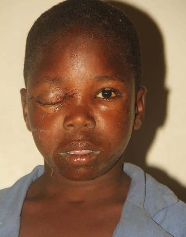 How suspected ritualists removed 12-year-old boy's eye in Bauchi